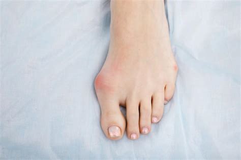 How to Keep Your Bunion Pain from Worsening: Arlington/Mansfield Foot ...