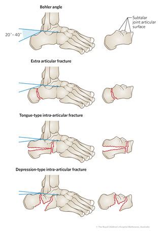 Calcaneus Fracture Classification