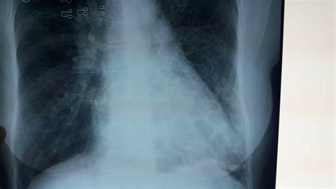 Bronchiectasis Chest X-ray || What is bronchiectasis - YouTube