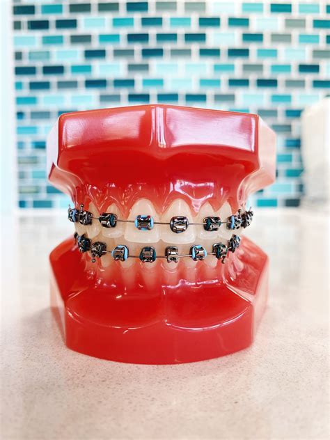 Top 10 Braces Color Combinations With Major Winter Vibes