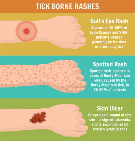 Tick bite rash – how to recognize the symptoms, treatment tips