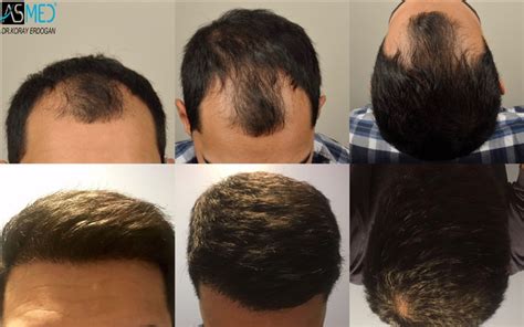 Norwood 4 Hair Transplantation Results | Asmed Hair Transplant