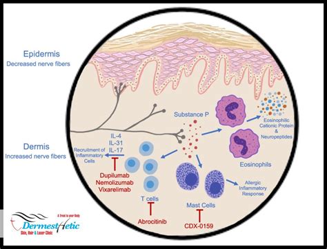 Nodular Prurigo (NP) / Prurigo Nodularis - Dermesthetic Clinic