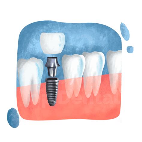 Top Dental | Implants
