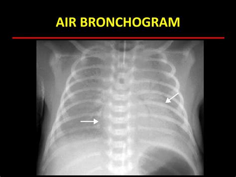 PPT - INTRODUCTION TO CHEST IMAGING for 5 th year medical students PowerPoint Presentation - ID ...