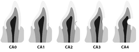 Cureus | The Cervical Abrasion Index of Treatment Needs (CAITN) Procedure for Population Groups ...