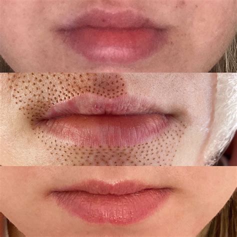 Lip Flip | Rejuva skin, Face treatment, Dermal fillers