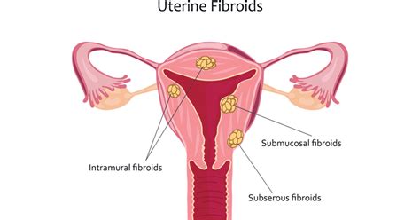 Uterine fibroids – Beveled Art Glass