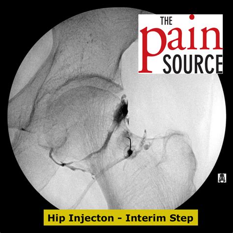 Hip Joint Injection With Fluoroscopy - Technique and Tips - ThePainSource.com