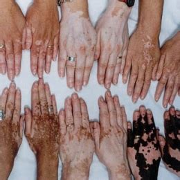 HypoPigmentation