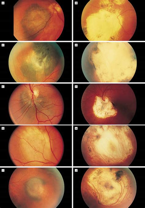 Cryotherapy as a Primary Treatment for Choroidal Melanoma | Melanoma ...