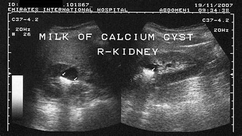 A Gallery of High-Resolution, Ultrasound, Color Doppler & 3D Images - Kidneys