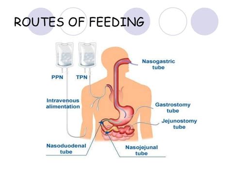 enteral feeding - Google Search Nursing Study, Nursing Tips, Speech ...