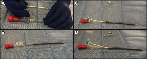 Inferior Vena Cava Filter Placement Through a Venovenous Extracorporeal Membrane Oxygenation ...