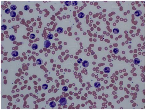 Neutrophil Disorders | Medical Laboratories