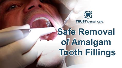 Safe Removal of Amalgam Tooth Fillings - YouTube