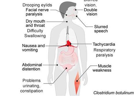 Botulism – Science of Healthy