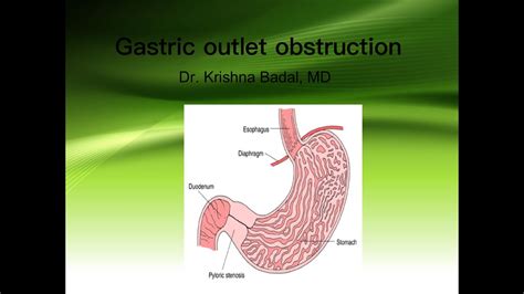 Gastric outlet obstruction - YouTube