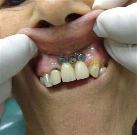 Dentaltown - Can you tell what went wrong with this anterior dental ...