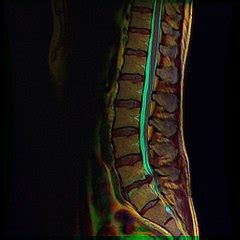 Category:MRI of Tarlov cyst - Wikimedia Commons