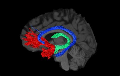 Tractography reconstruction example from one individual (right side... | Download Scientific Diagram