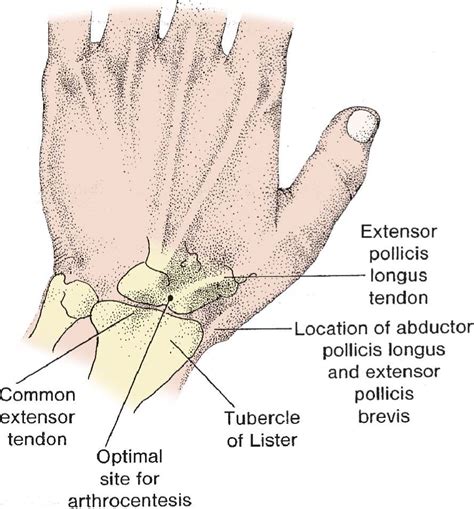 Wrist (Radiocarpal) Arthrocentesis | Anesthesia Key