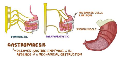 Gastroparesis: Symptoms, Causes, Diagnosis Treatment, 52% OFF