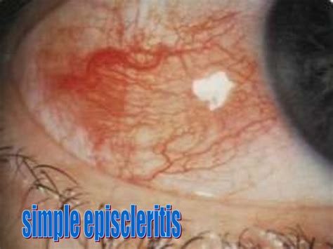 Episcleritis & scleritis