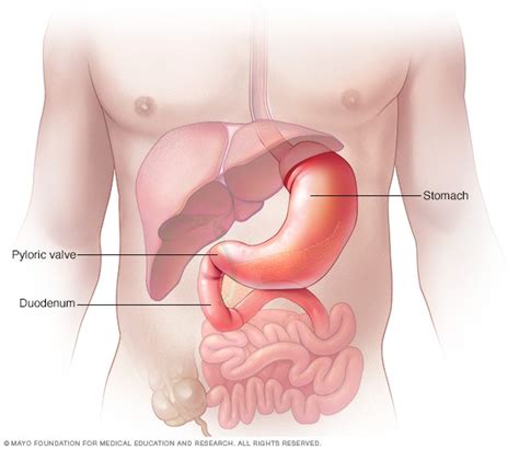 Gastritis - Symptoms and causes - Mayo Clinic