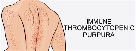 Immune Thrombocytopenia: Causes, Symptoms And Treatment