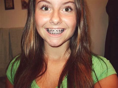 Black Braces For Teeth - Teeth Braces Ideas | Orthodontie