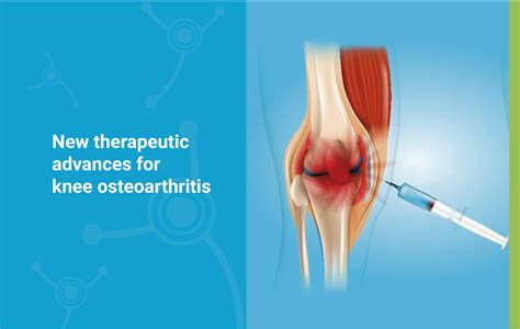 New therapeutic advances for knee osteoarthritis - Arthrosis Clinic