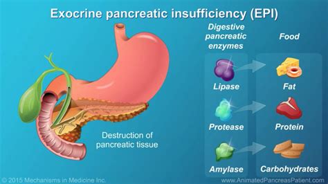 Exocrine Pancreatic Insufficiency (EPI) AGA GI Patient, 57% OFF