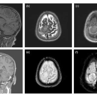 MRI demonstrating meningioma at the apex of the tentorial incisura: (a)... | Download Scientific ...