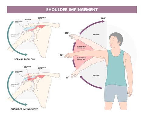 Shoulder Impingement Exercises - Best Advice in 2024