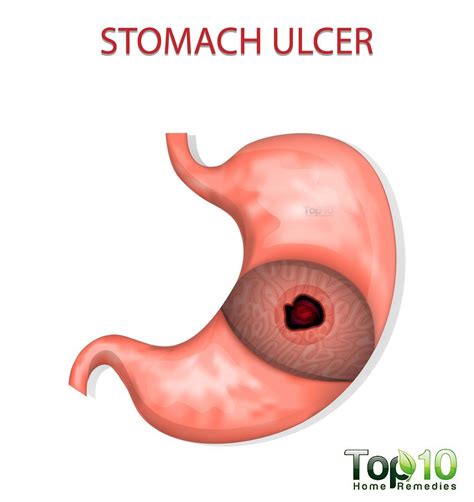 10 Signs and Symptoms of a Stomach Ulcer You Should Not Ignore | Top 10 ...