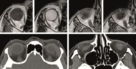 A, B, and E: Normal superior orbital septum (blue arrow) on the axial... | Download Scientific ...