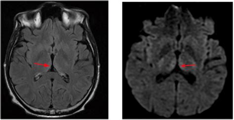 Cerebral MRI images showing hyperintense signal of the periaqueductal... | Download Scientific ...