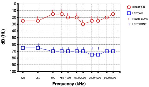 Profound Sensorineural Hearing Loss Audiogram