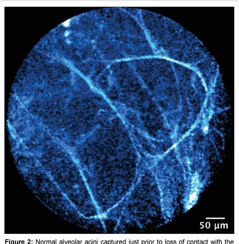 Figure 1 from Probe-Based Confocal Laser Endomicroscopy of the Lungs ...