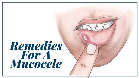 Mucocele - Home remedies for a mucocele | Removal | Treatment | Mucocele mouth | Home remedy ...