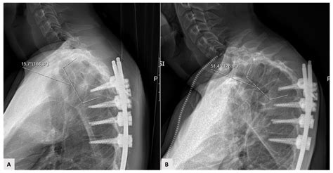 JCM | Free Full-Text | Mechanical Complications in Adult Spine Deformity Surgery: Retrospective ...