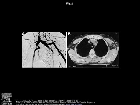 Crushed stents in benign left brachiocephalic vein stenoses - ppt download