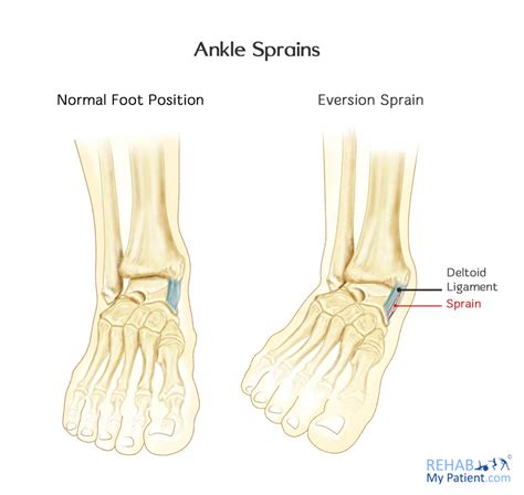 Ankle Sprains (Medial and Lateral) | Rehab My Patient