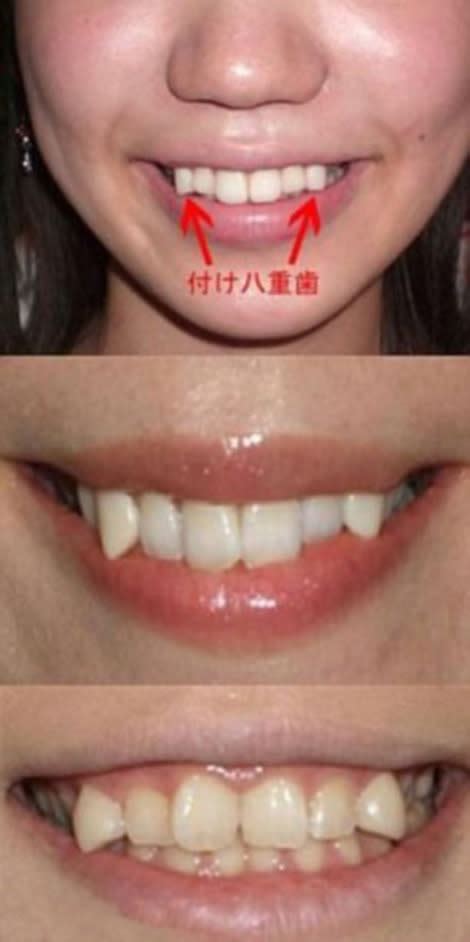 Japanese Snaggletooth Craze Spawns Dental Procedures, Girl Group