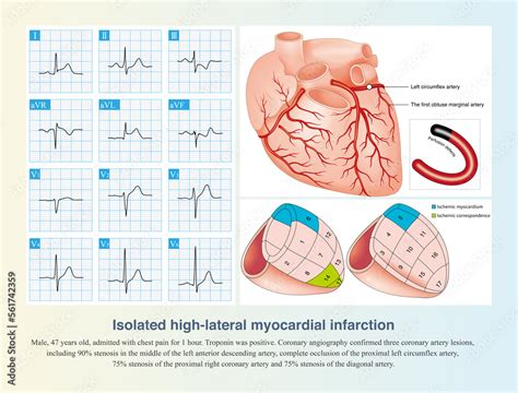 Acute High Lateral Myocardial Infarction Indicative Segment