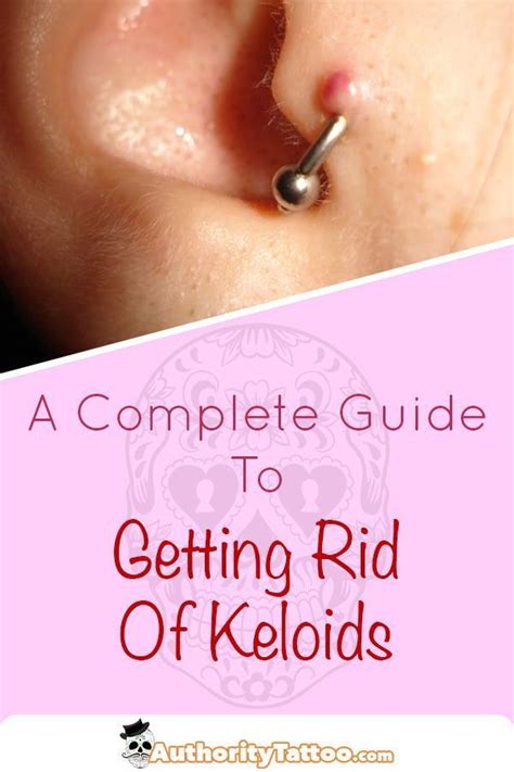 Everything you need to know about getting rid of keloids around your ...