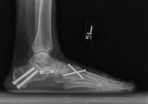 Posterior Tibial Tendon Insufficiency (PTTI) - Foot & Ankle - Orthobullets