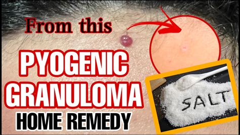 PYOGENIC GRANULOMA HOME REMEDY | 100% EFFECTIVE! Step by step ...