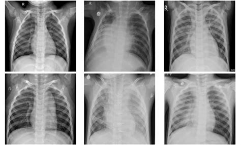 BLOGGER BLOG: ΟΙ ΕΙΔΗΣΕΙΣ ΤΩΝ ΘΕΤΙΚΩΝ ΕΠΙΣΤΗΜΩΝ: Machine learning framework classifies pneumonia ...